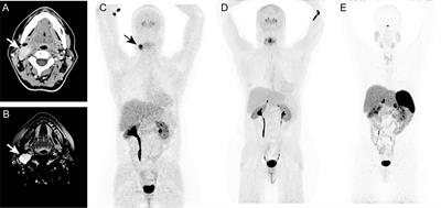 Identification of Isocitrate Dehydrogenase 2 (IDH2) Mutation in Carotid Body Paraganglioma